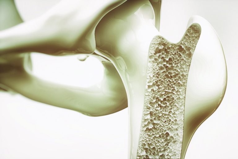 Osteoporoz (Kemik Erimesi)